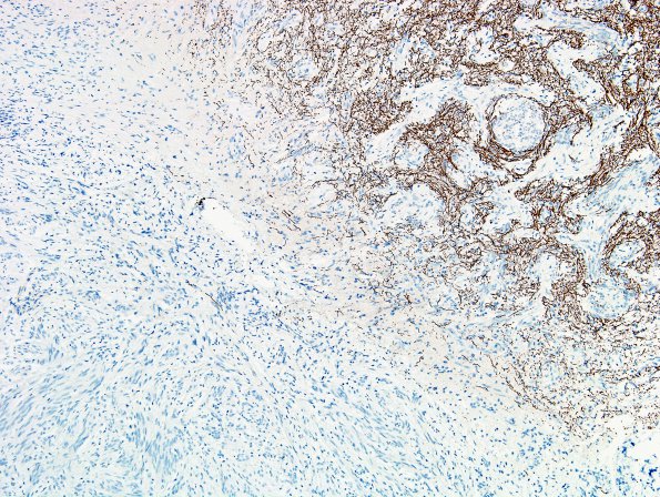 5D1 Angiocentric Glioma (Case 5) NF 4.