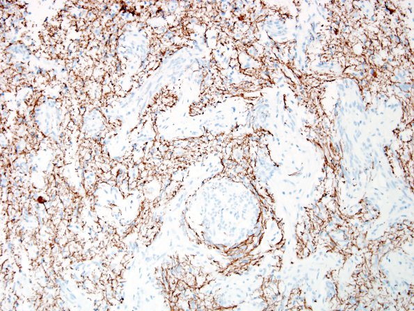 5D2 Angiocentric Glioma (Case 5) NF 1