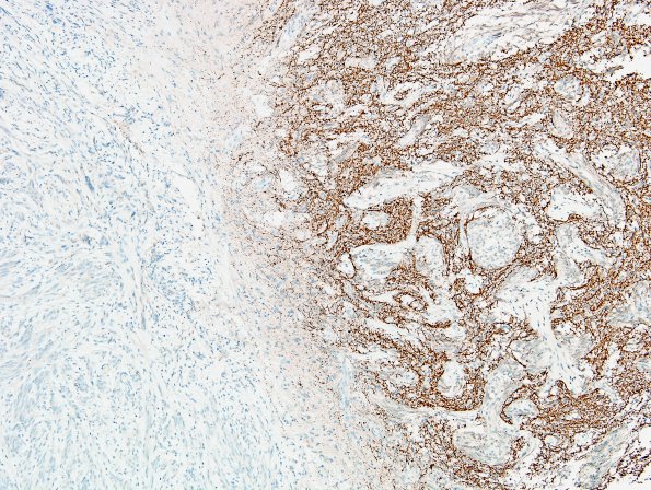 5E1 Angiocentric Glioma (Case 5) SYN 2.