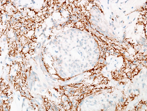 5E2 Angiocentric Glioma (Case 5) SYN 4