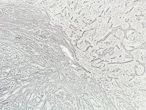 5F Angiocentric Glioma (Case 5) Retic