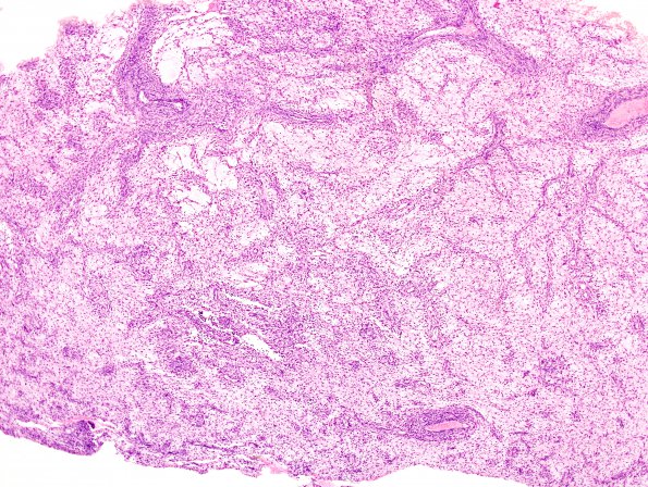 6A1 Angiocentric Glioma (Case 6) H&E 18