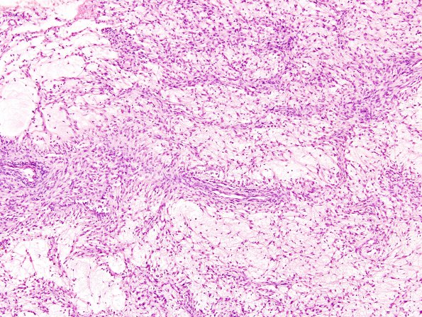 6A2 Angiocentric Glioma (Case 6) H&E 17