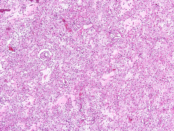 6A3 Angiocentric Glioma (Case 6) H&E 1