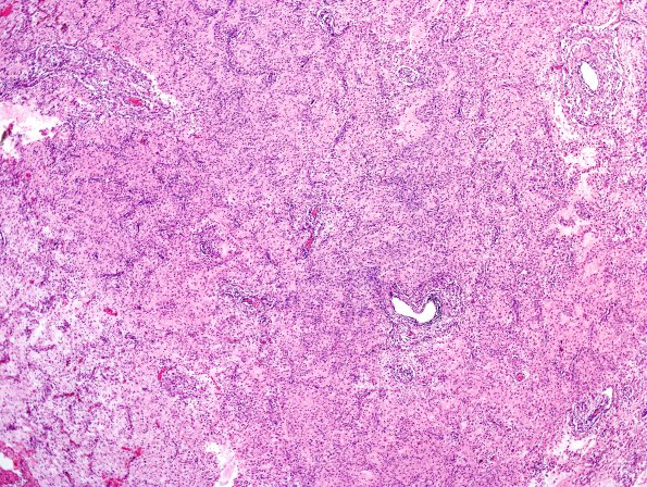 6A4 Angiocentric Glioma (Case 6) H&E 21