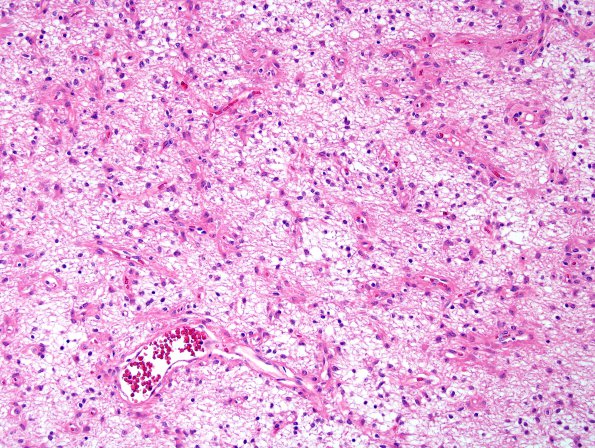 6A5 Angiocentric Glioma (Case 6) H&E 6