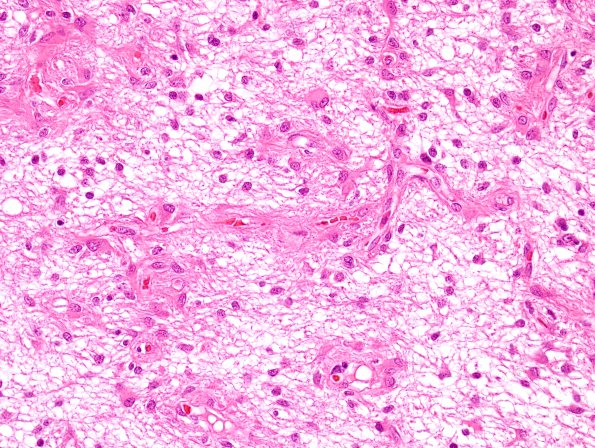 6A6 Angiocentric Glioma (Case 6) H&E 7