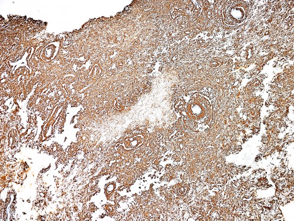 6B1 Angiocentric Glioma (Case 6) GFAP 6