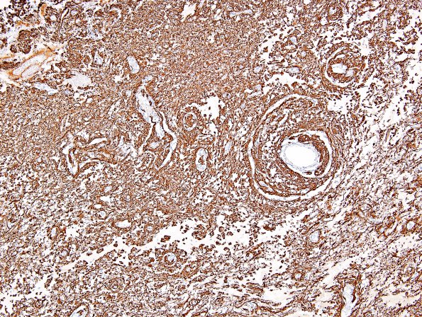 6B2 Angiocentric Glioma (Case 6) GFAP 4