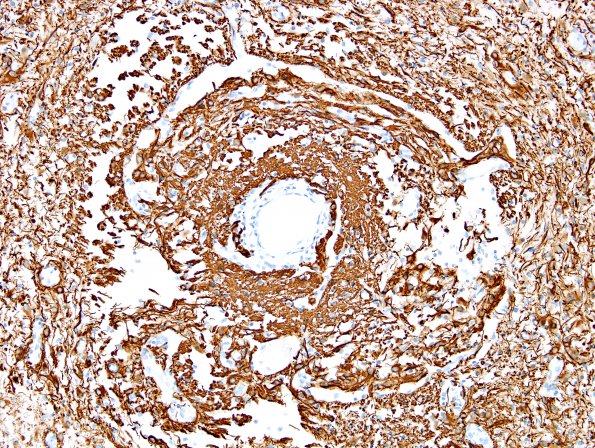 6B3 Angiocentric Glioma (Case 6) GFAP 3