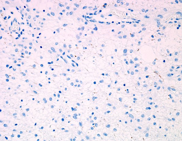 6C1 Angiocentric Glioma (Case 6) NF