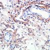 6C2 Angiocentric Glioma (Case 6) SYN 2