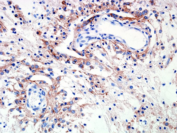 6C2 Angiocentric Glioma (Case 6) SYN 2