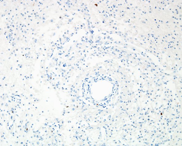 6D Angiocentric Glioma (Case 6) MIB-1 5