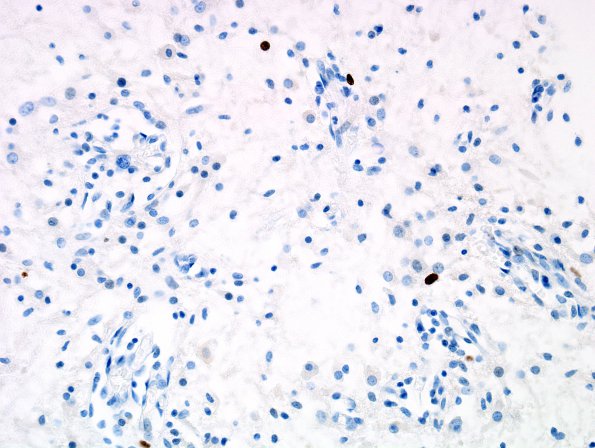 6E2 Angiocentric Glioma (Case 6) MIB-1 2