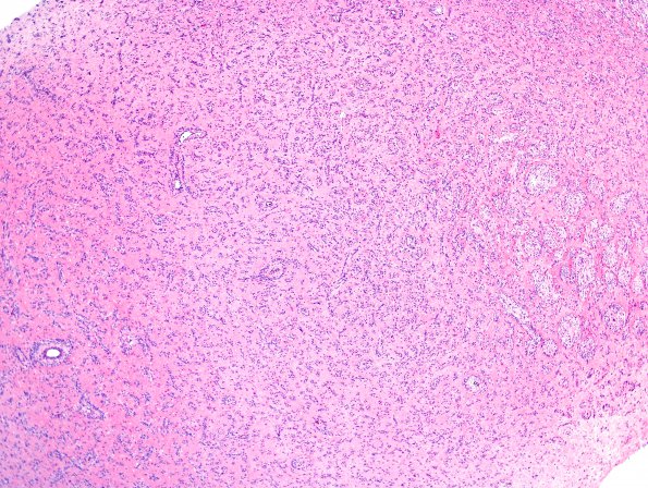 7A1 Angiocentric glioma (Case 7) H&E 1.j