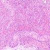 7A10 Angiocentric glioma (Case 7) H&E 7.j