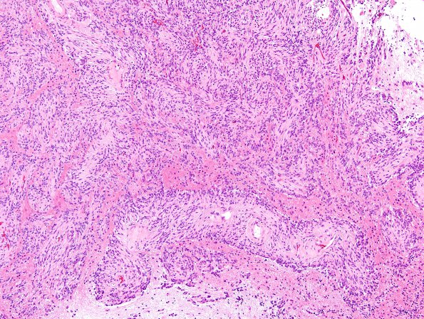 7A10 Angiocentric glioma (Case 7) H&E 7.j