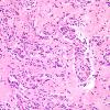 7A11 Angiocentric glioma (Case 7) H&E 9.