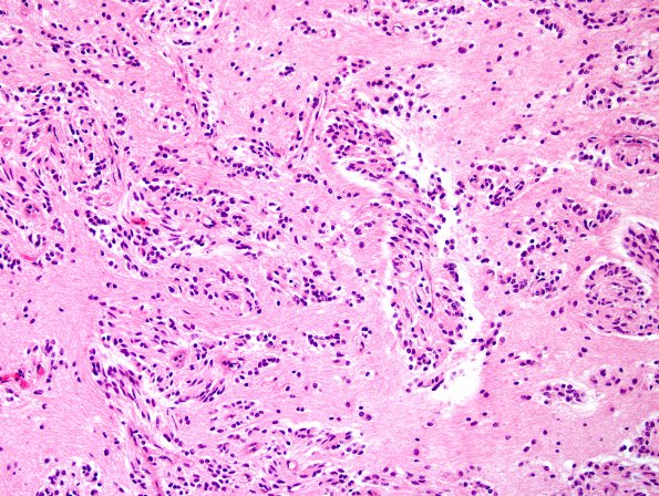 7A11 Angiocentric glioma (Case 7) H&E 9.