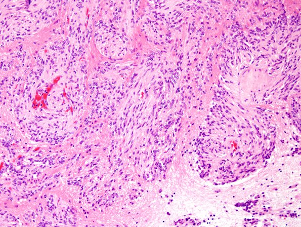 7A12 Angiocentric glioma (Case 7) H&E 17