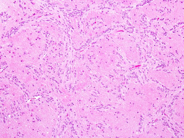 7A2 Angiocentric Glioma (Case 7)