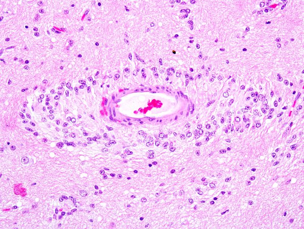 7A3 Angiocentric Glioma (Case 7) 2.j