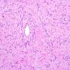 7A4 Angiocentric Glioma (Case 7) 3.