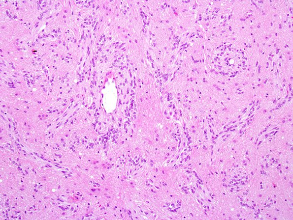 7A4 Angiocentric Glioma (Case 7) 3.