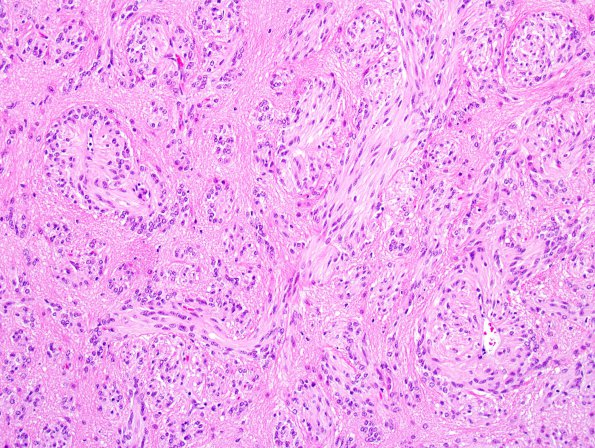 7A5 Angiocentric Glioma (Case 7) 4