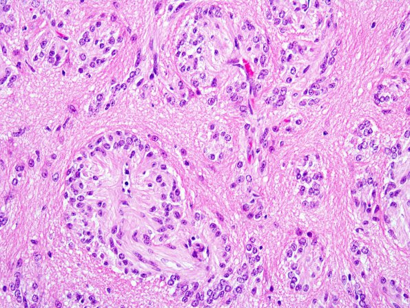 7A6 Angiocentric Glioma (Case 7) 5