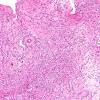 7A7 Angiocentric glioma (Case 7) H&E 3.