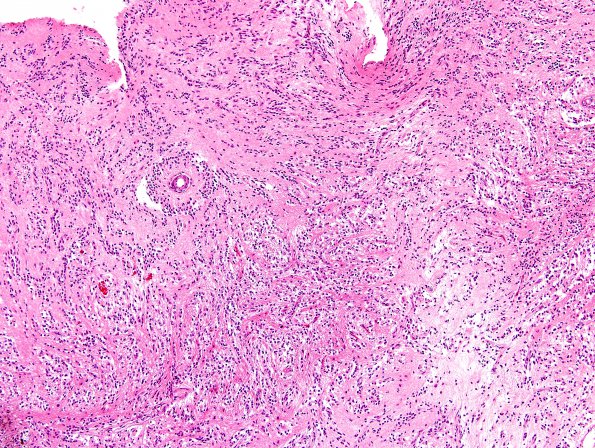 7A7 Angiocentric glioma (Case 7) H&E 3.