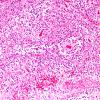 7A8 Angiocentric glioma (Case 7) H&E 4.