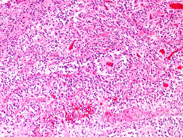 7A8 Angiocentric glioma (Case 7) H&E 4.