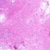 7A9 Angiocentric glioma (Case 7) H&E 5