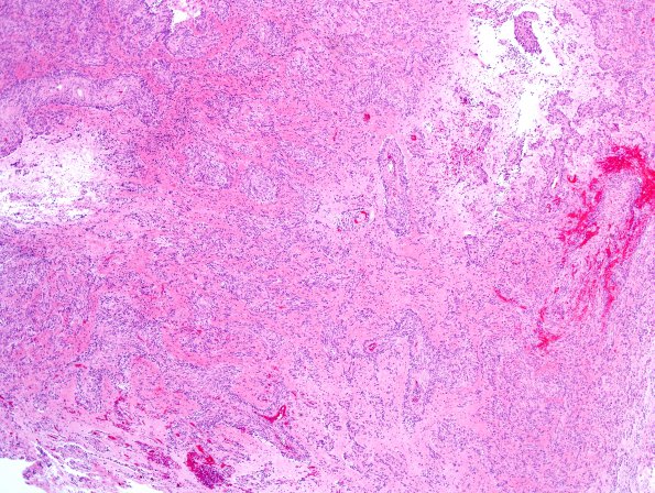 7A9 Angiocentric glioma (Case 7) H&E 5