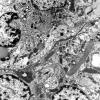 7B1 Angiocentric glioma (Case 7) EM 2 - Copy