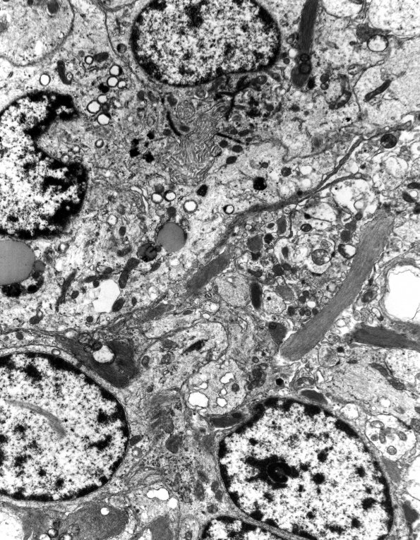 7B1 Angiocentric glioma (Case 7) EM 2 - Copy