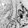 7B2 Angiocentric glioma (Case 7) EM 3 copy - Copy