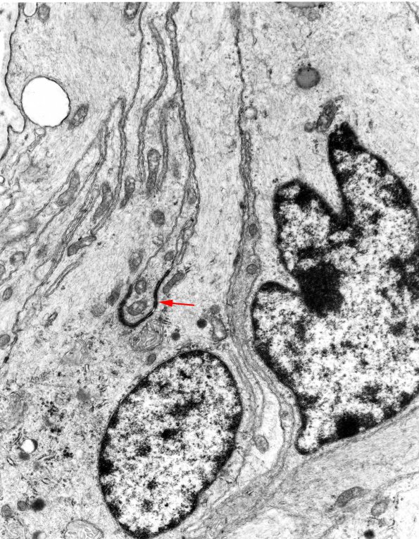 7B2 Angiocentric glioma (Case 7) EM 3 copy - Copy