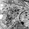 7B3 Angiocentric Glioma (Case 7) EM 8 - Copy