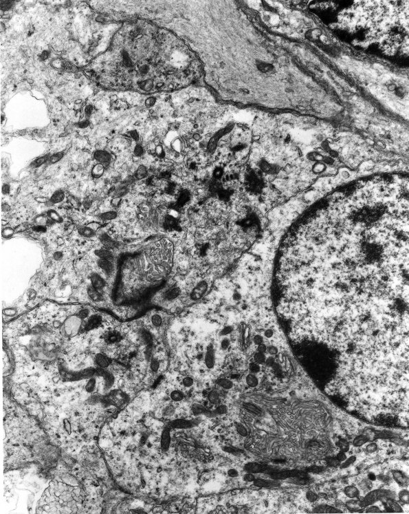 7B3 Angiocentric Glioma (Case 7) EM 8 - Copy