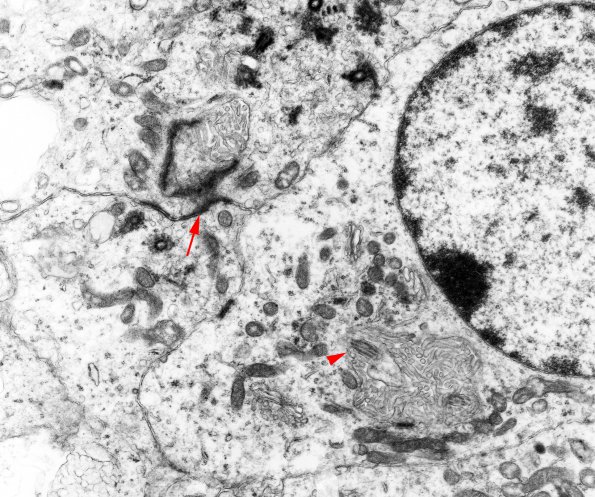 7B4 Angiocentric Glioma (Case 7) EM 15 copy copy - Copy