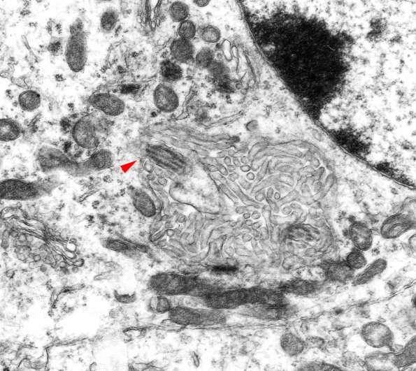 7B5 Angiocentric Glioma (Case 7) EM 9 copy - Copy