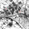 7B6 Angiocentric Glioma (Case 7) EM 13 copy - Copy