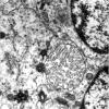 7B7 Angiocentric Glioma (Case 7) EM 5 - Copy