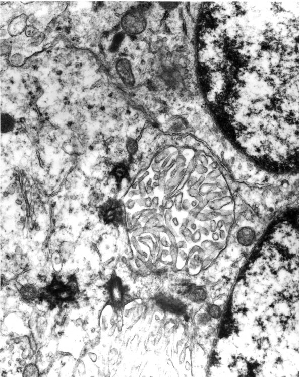 7B7 Angiocentric Glioma (Case 7) EM 5 - Copy