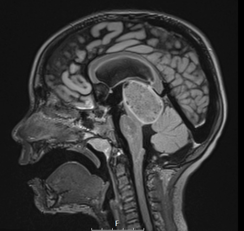 8A1 Angiocentric glioma (Case 8) FLAIR W 2 A