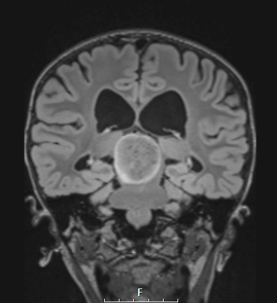8A2 Angiocentric glioma (Case 8) FLAIR W A